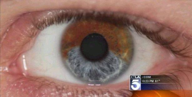 laser-eye-color