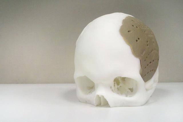 3d-skull-implant