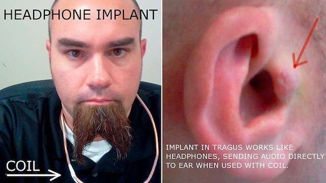 headphone-implant